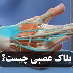 بلاک عصبی چیست