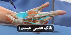 بلاک عصبی چیست