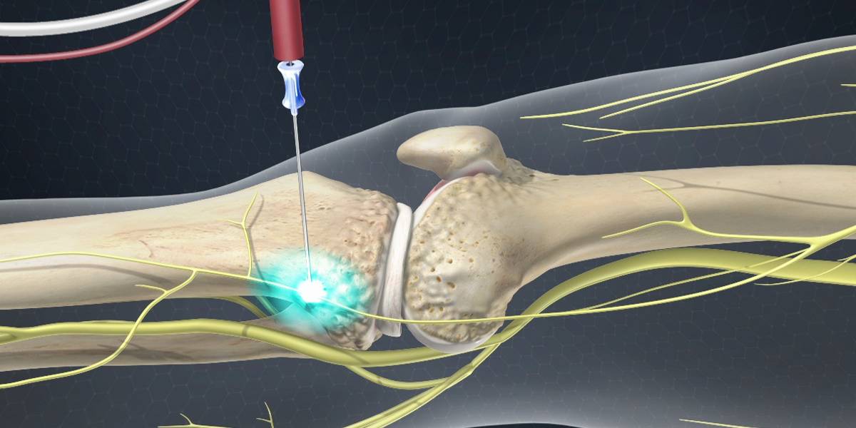 نورولیز عصبی