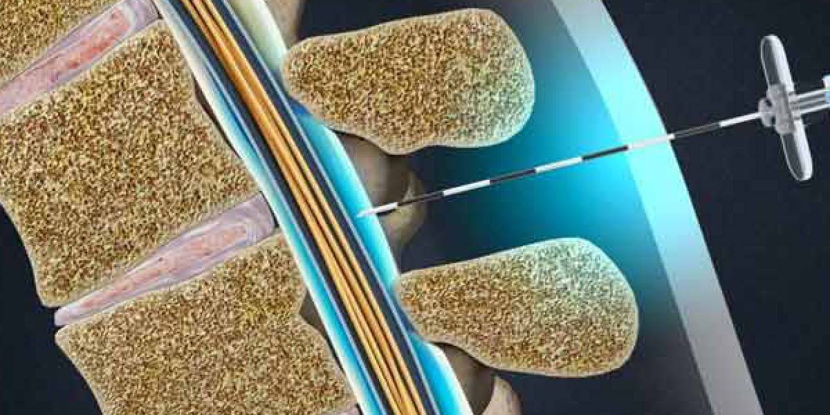 نحوه انجام تزریق اپیدورال